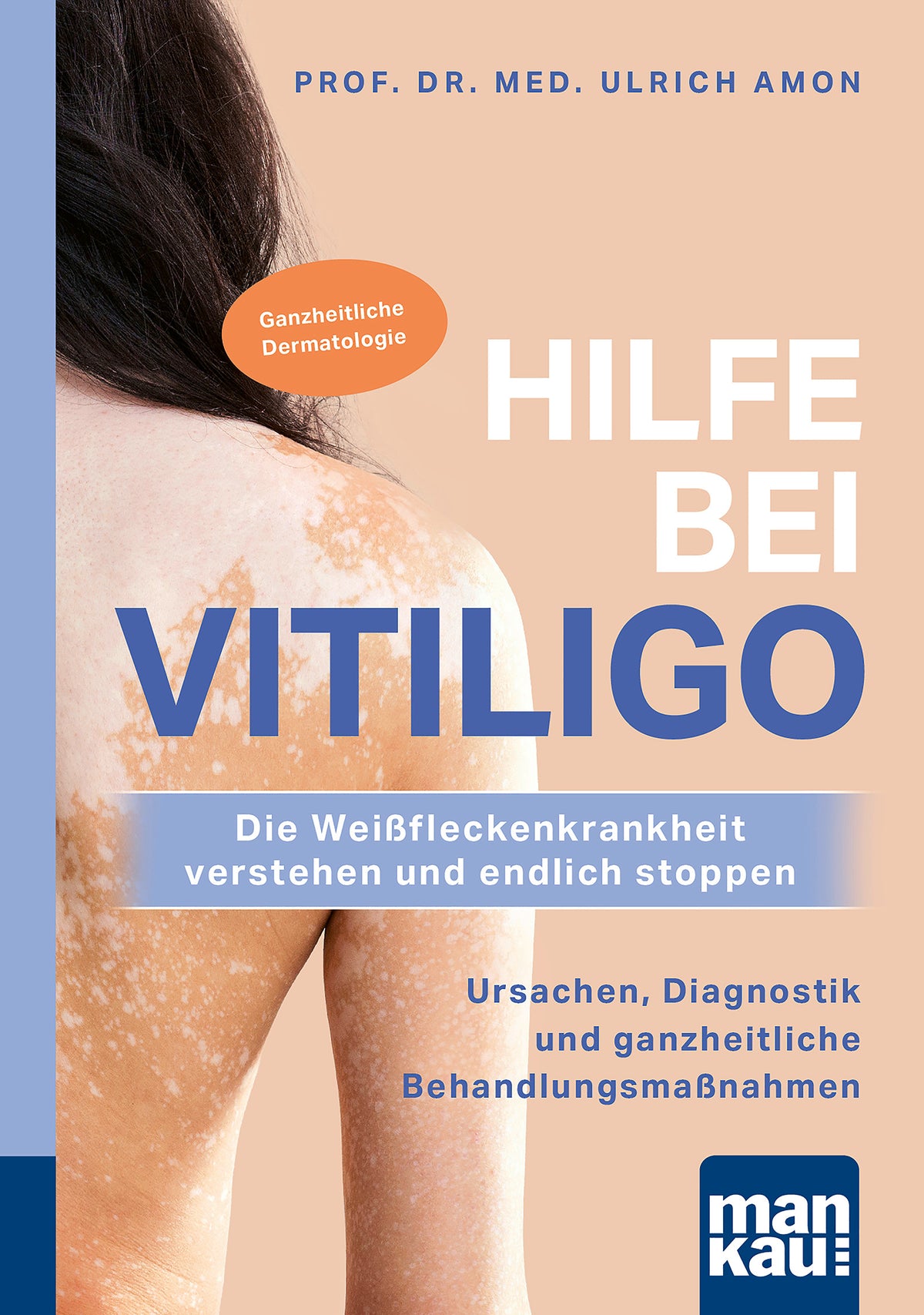 Hilfe bei Vitiligo